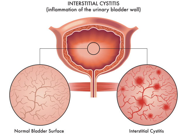 Treating bladder pain syndrome or interstitial cystitis naturally